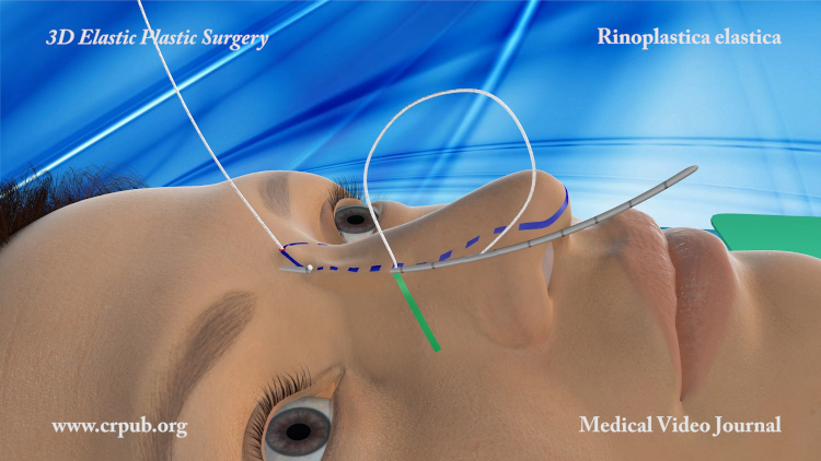 Rinoplastica elastica con Elasticum